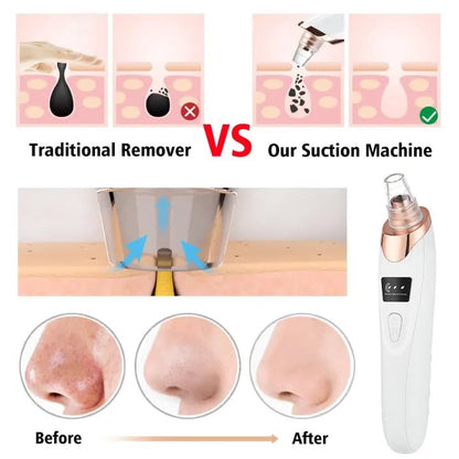 Professional Electric Blackhead Remover Vacuum - The HC Store